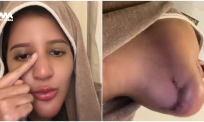 Isteri Azlan Komeng terseksa buang silikon