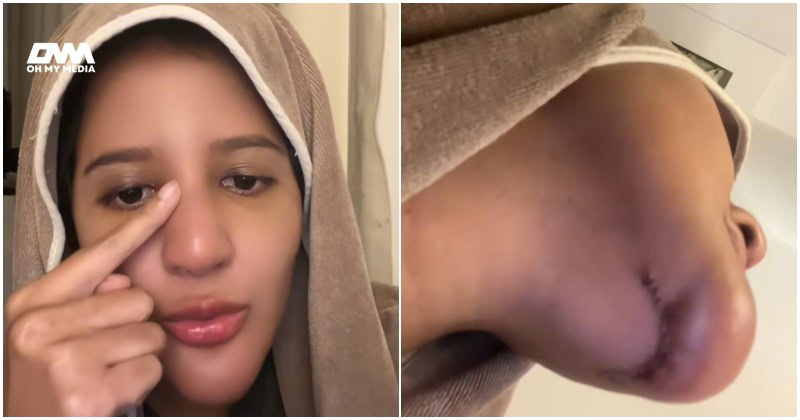 Isteri Azlan Komeng terseksa buang silikon
