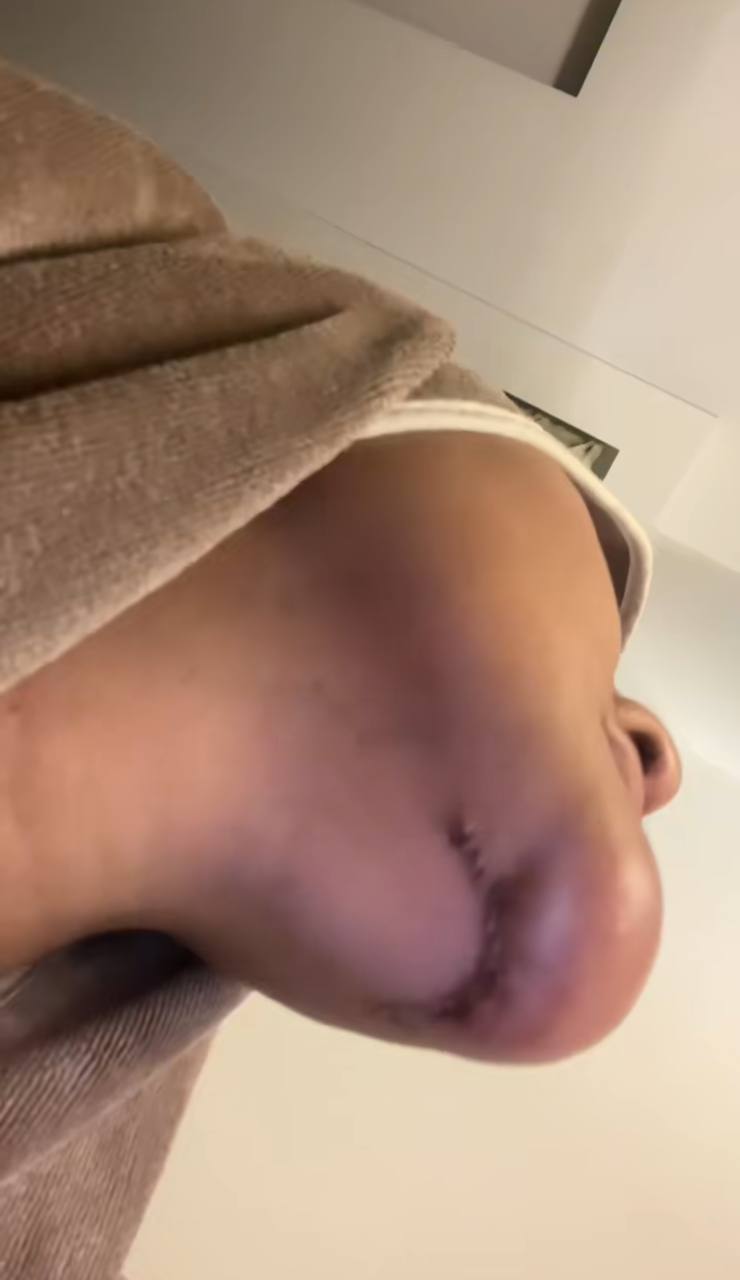 Isteri Azlan Komeng terseksa buang silikon