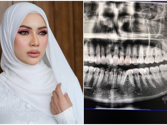 Doktor sangka pakai susuk