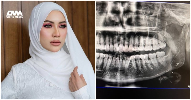 Doktor sangka pakai susuk